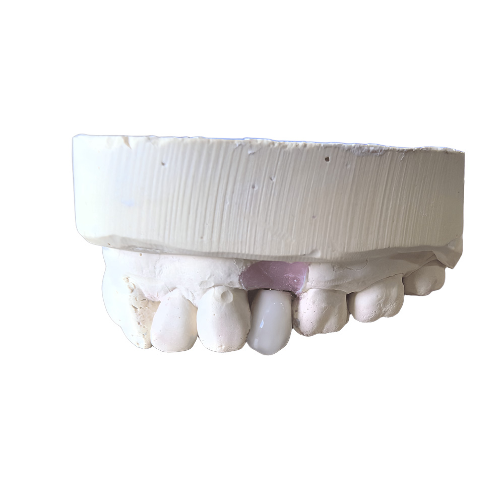 A1 Zirconia Crowns - case 3