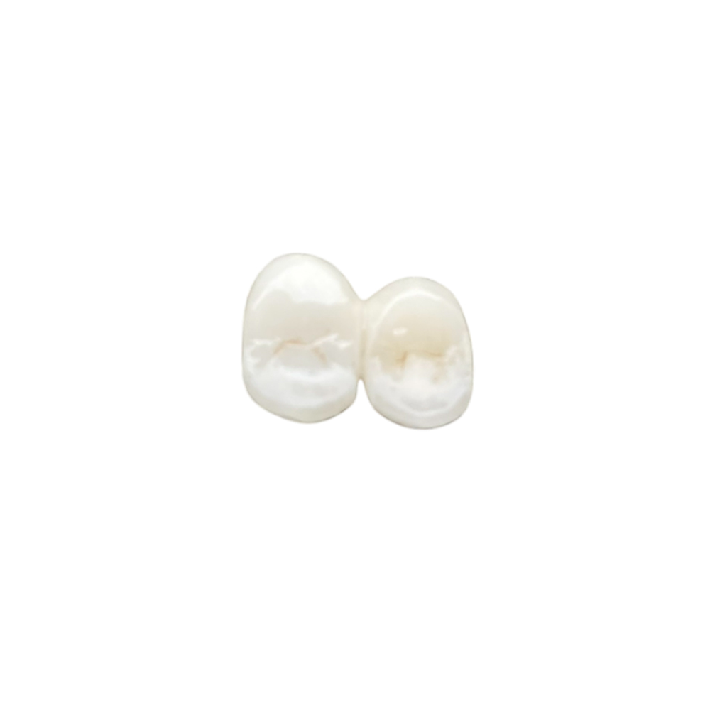 B1 Zirconia Crowns - case 3