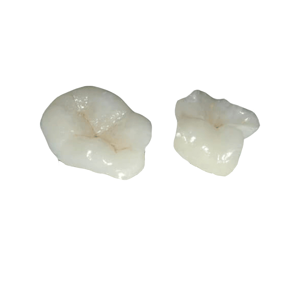 Ceramic Porcelain Inlays And Onlays
