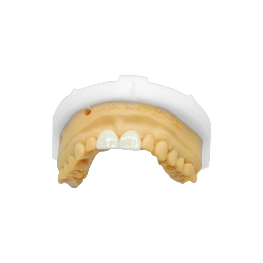 Ceramic Veneers