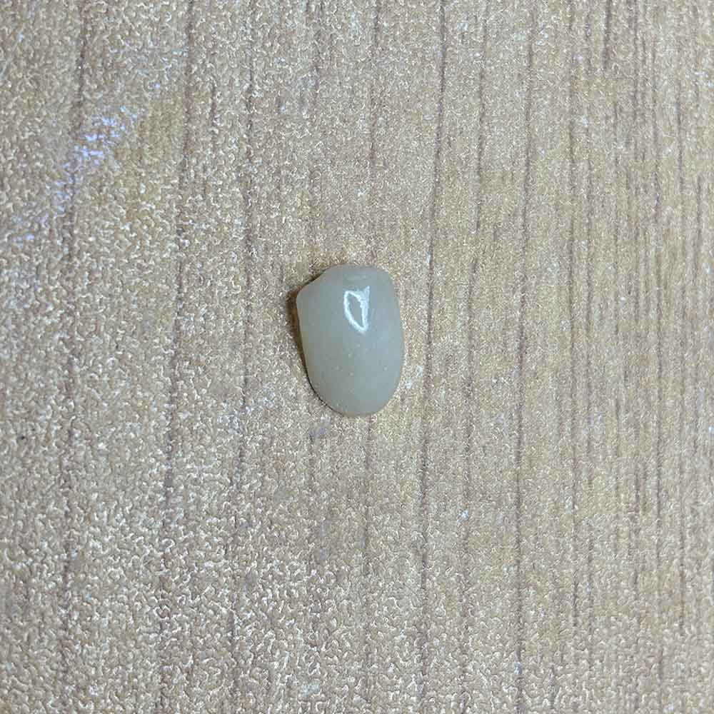 Composite Veneers - case 2
