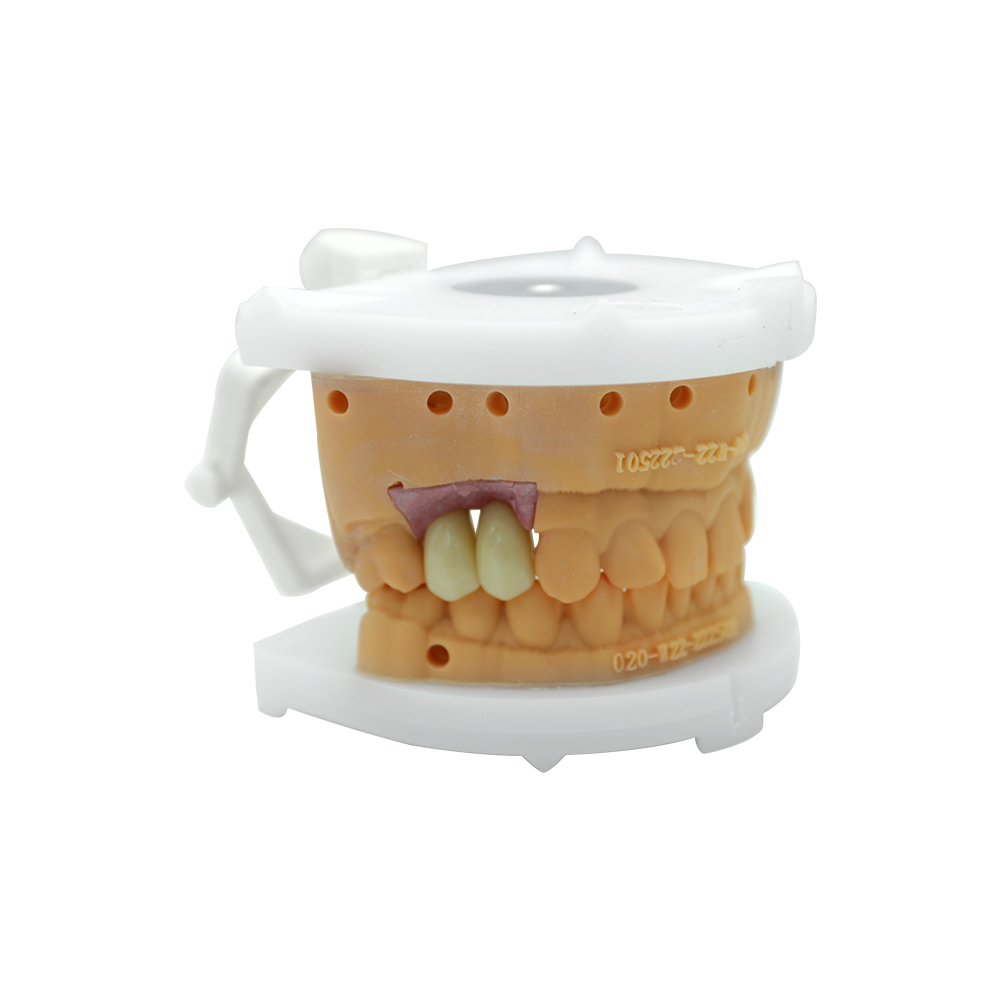 Dental Implant Prosthetics - case 2