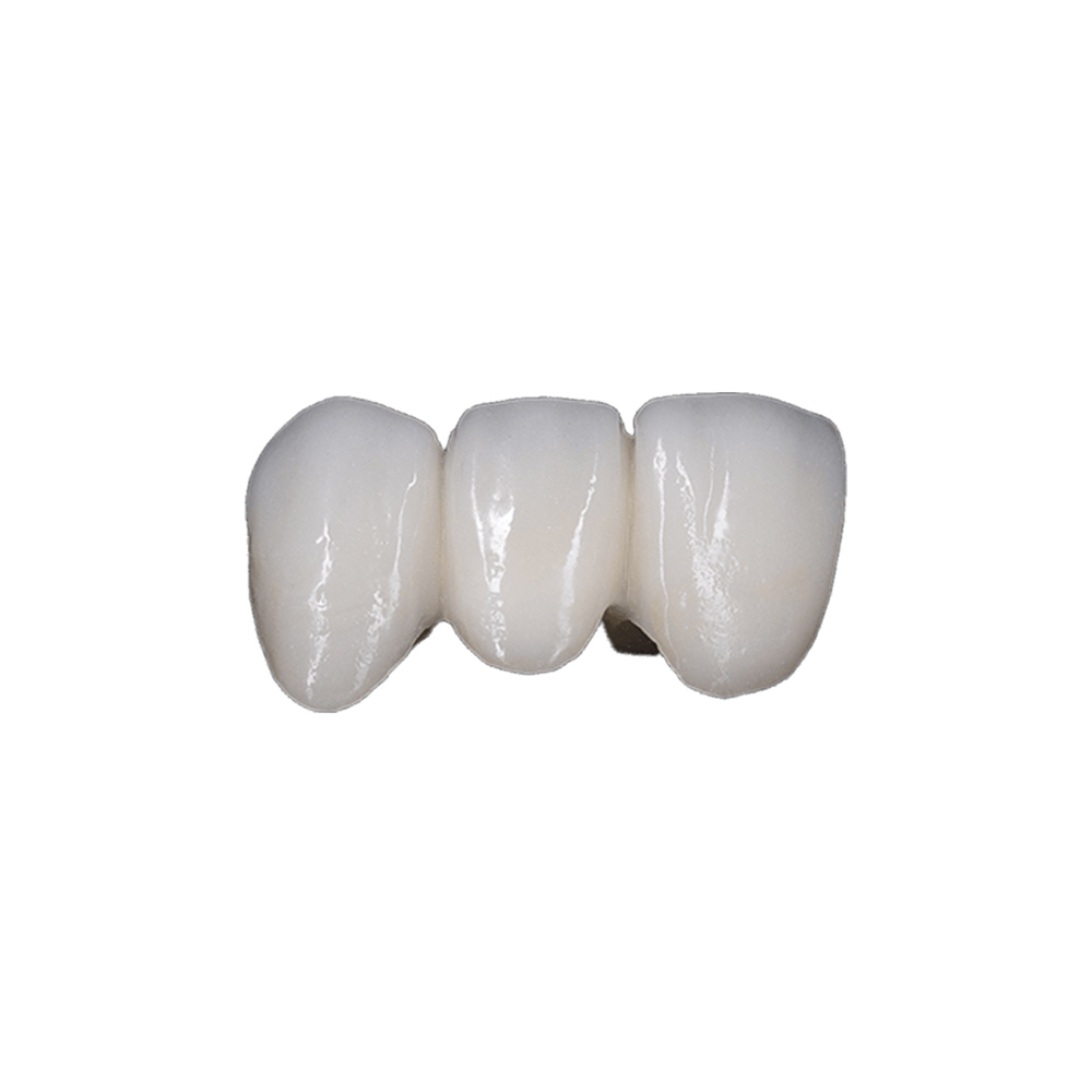 Emax Crowns Front Teeth - case 2
