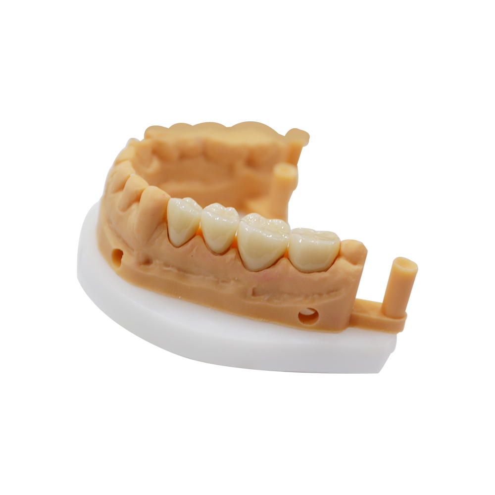 Full Contour Zirconia Crown and Bridge