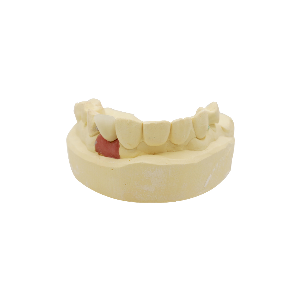 Lateral Incisor Implant