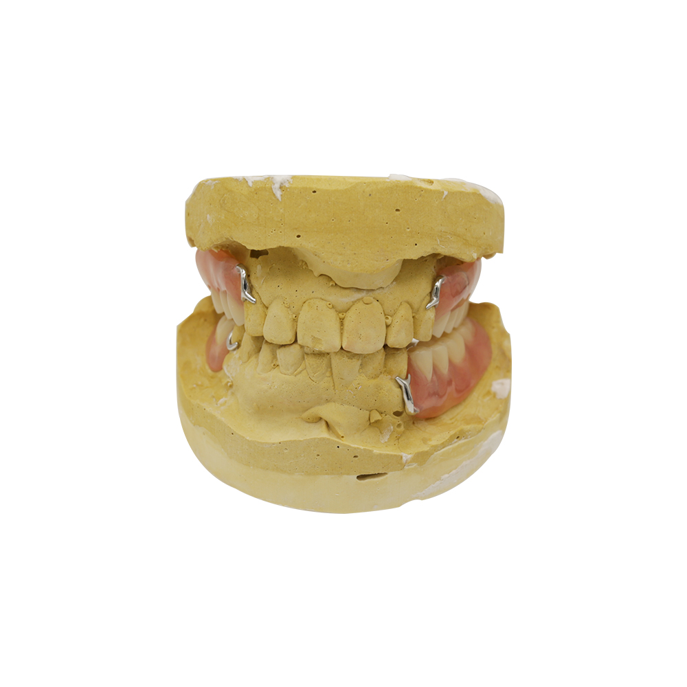 Partial Metal Dentures with Clasps - case 2