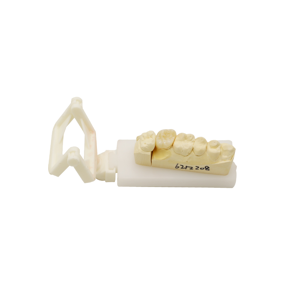 PFM Crown Posterior - case 2