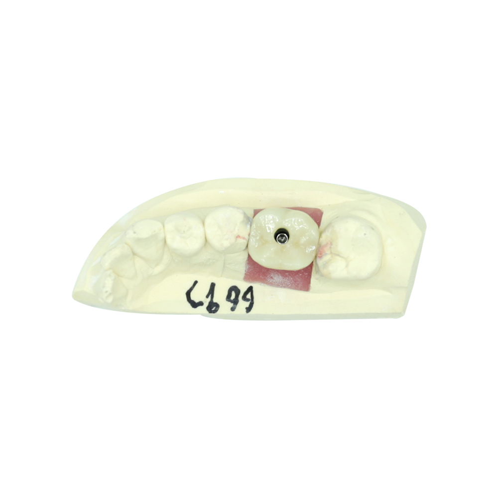 Screw Retained Implant Crown - case 3
