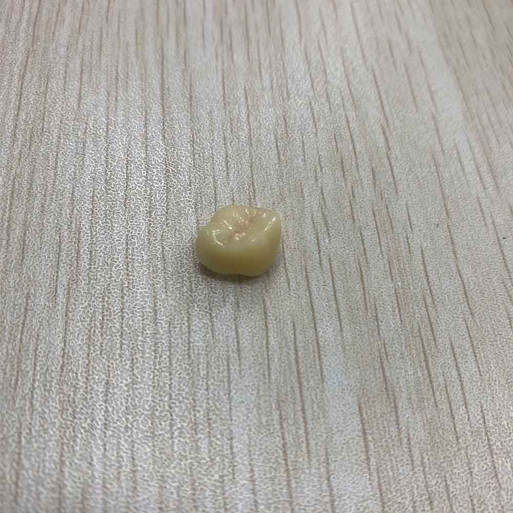 Temporary Lower Teeth - case 3