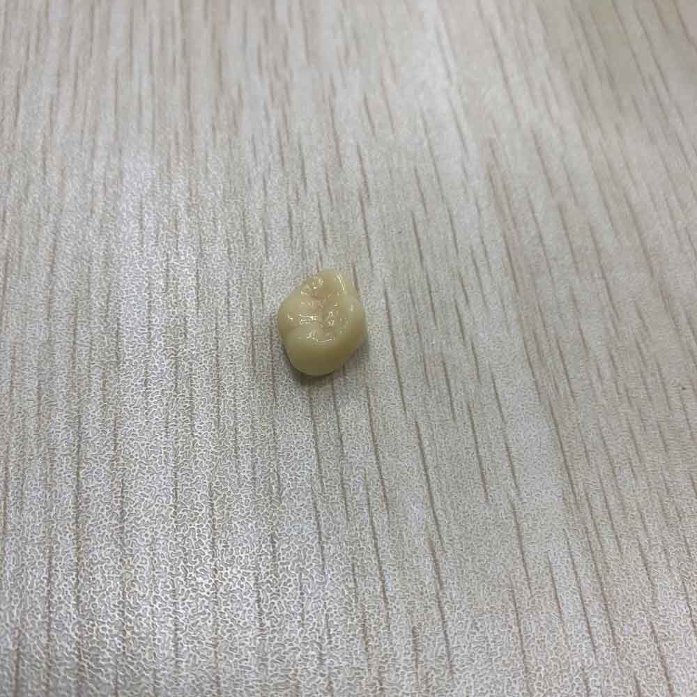 Temporary Molar Tooth - case 2