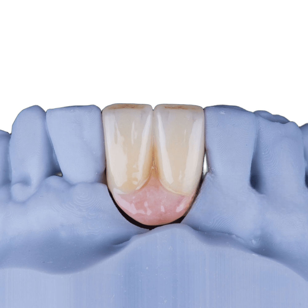 Two Teeth On One Implant
