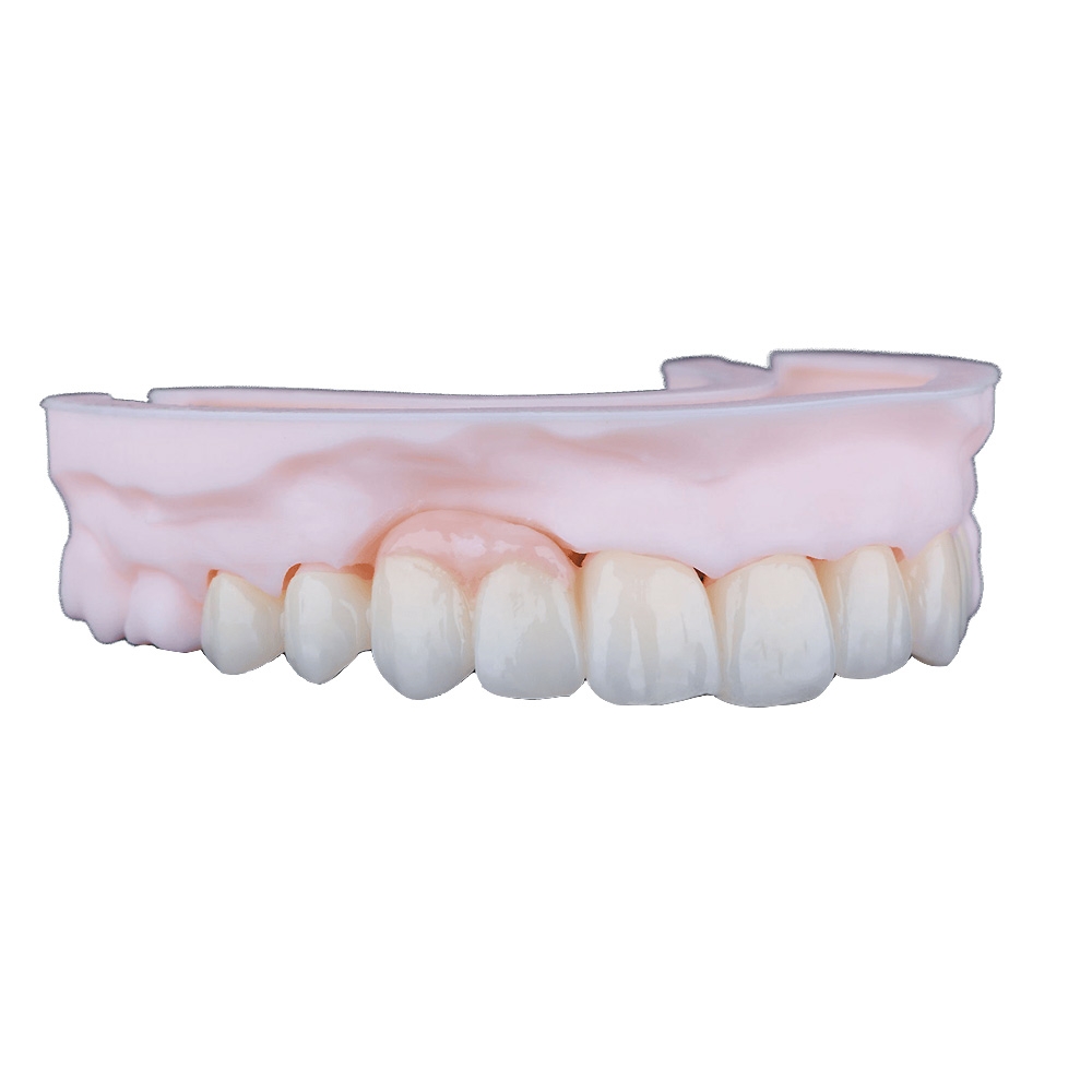 White Zirconia Crowns - case 2